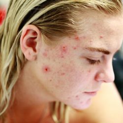 Cicatrices d’acné : comment les atténuer ?
