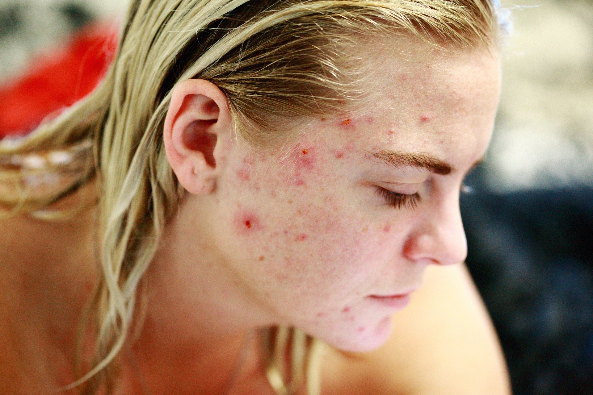 Cicatrices d’acné : comment les atténuer ?