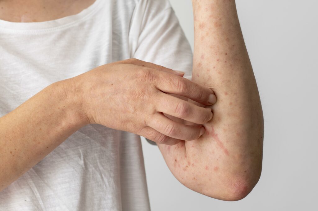 eczéma et psoriasis